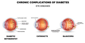 اثر دیابت بر روی چشم ها+ نرم افزار های تخصصی درمان دکتر